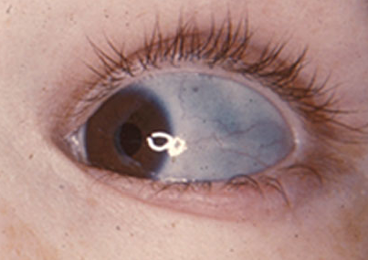 Oeil bleu (ostéoporose imparfaite)