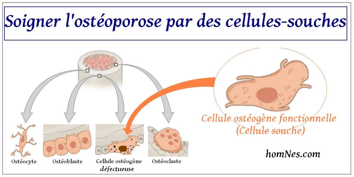Soigner l'ostéoporose grâce aux cellules souches