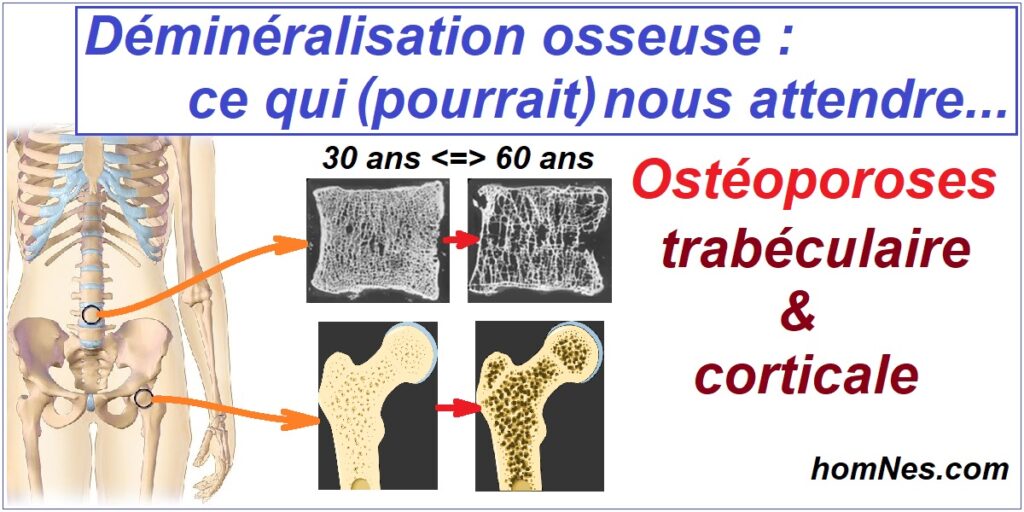 Ostéoporose & Ostéopénie - Trabéculaire ou Corticale - homnes.com